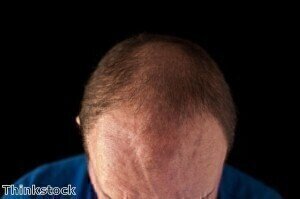Biological clue to male baldness